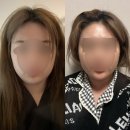 엔슬림의원 | 내돈내산 얼굴지흡후기 ,,? 지흡일기,,? 얼굴지방흡입후기 / 얼굴지방흡입효과