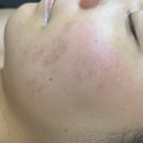 몽프로디 | 신림피부관리 추천 :) 신림동 몽프로디 방문 후기 ! 스피큘관리 받았어요!
