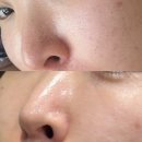 헤드테라피in윤미라 | 미사모공관리 모공세척 블랙헤드 화이트헤드 요철 싹 지워진 고원장의모공세척테라피