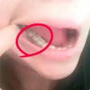 아로마모라 | 양재치과 어금니 오스템 임플란트 가격 기간 후기