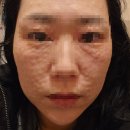 나은필병원 | 광주 리쥬란힐러 아쿠아필 내돈내산 찐 후기