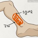 5월 하지정맥류 고주파 수술 회복기, 신경손상 감각저하, 한달 후기, 일상생활