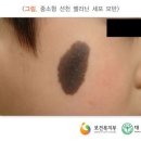 선천성 화염상 모반의 치료를 위한 혈관레이저수술이 당해보험 약관에서 정하고 있는 수술급여금의 지급사유에 해당하는지 여부[Q82.5] 이미지