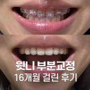 서울바른 치과교정과치과의원 | 윗니치아교정 후기
