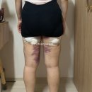 오렌지케어 | 기록 #2 | 신촌 허벅지 무한람스 일주일 경과 리얼 후기! (멍, 통증, 운동, 오렌지케어, 일상생활 리뷰)