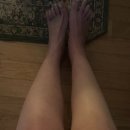 모세휠체어 | 발목 골절 수술 기브스 풀고 핀 제거 수술 전 후기 2화