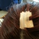 승재한의원 | [수술 후기] 속 편한 외과에서 지방종 수술