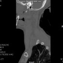 공주대학교 1조 장민철, 정유진_case study_T-SAH 이미지