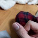 사마귀 제거 없애는법, 손사마귀, 사마귀치료, 사마귀 제거후, 티눈 생기는 이유, 티눈 초기, 티눈 밴드