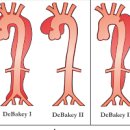 대동맥 박리 파열 증상 급성심부전증까지 주의보 이미지
