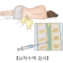 2. 뇌척수액검사 이미지