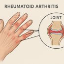 심낭골 | 류마티스 관절염 당하동 한의원