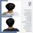 원스칼프 이미지