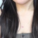 연세복싱 | 켈로이드 흉터치료 제거 수술 2달 차 후기; 연세스타 켈로이드 치료