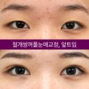 아이케이성형외과의원 네이버블로그