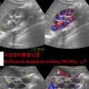 다낭성이형성신장 Multicystic dysplastic kidney (MCDK) 이미지