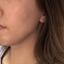 강남역 | 울쎄라 티타늄리프팅 효과 가격 강남역피부과 후기