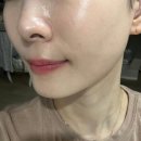 은하스킨케어 | 목동피부과 엘라비에 리투오 효과, 통증 내돈내산 후기