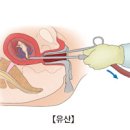 계류 절박 습관성 화학적 인공 유산 종류 증상 원인 후 몸조리 까지 담았어요 이미지