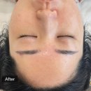 베니히룸 | 내돈내산) 민감피부도 가능한 안양 평촌 ‘베니히룸’ 모공탄력 플라즈마 관리 솔직후기&전후비교