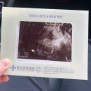 (주)스마일커뮤니티 | [임신초기 ~6주차] 초음파 아기집 확인 (스마일배테기, 좋은문화병원, aka한방이)