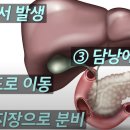 담도암, 치료와 예방법은 이렇습니다.ㅣ천재경 서울아산병원 종양내과 [이러면 낫는다ㅣ담도암] 이미지