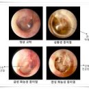 중이염 증상 성인 소아 중이염 중이염 원인 성인 중이염 원인 이미지