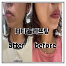 수원 세모아의원 티타늄리프팅 후기 솔직한 7일의 변화 과정 이야기 수원인계동리프팅 추천합니다