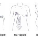 [에이블성형외과] 가슴재수술 방법과 장단점(유방재건술) 이미지