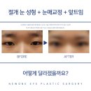 뉴원성형외과의원 | 눈매교정 고민 중이라면 부산 절개 눈 성형 눈매교정 앞트임 후기로 알아보세요!