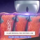 멍짱 | 청주 피부과 티타늄리프팅 내돈내산 후기! 가격·통증·멍·주기 (ft. 원장님 짱친절 상담왕)