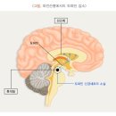 "노년의 적 파킨슨병…한국인 위험요인 1위는 운동부족" 이미지