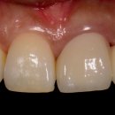 히트성형외과의원 | 강동구 치과 보철과 전문의 젊은 여성분 앞니 올세라믹 크라운 교체