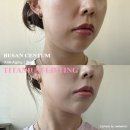 깔끔하군 | 부산 피부과 후기 티타늄리프팅 레이저시술, 심부볼 이중턱 개선 효과 및 통증 주의사항