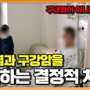 입안에 난 이 하얀색 단순 구내염인 줄 알고 놔뒀다가 암이 된다 이미지