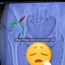 GS25속초보광병원점 | 수술기록] 비구이형성증 회전절골술 2차 :: 좌측(경희의료원)에 이어 우측(속초보광병원) 수술 병상일지 #0