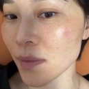 미안예 | 기미 잡티제거 레이저 장희빈미안법 효과 후기