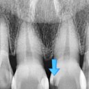 테마치과기공소 | 앞니 치료에 진심인 서울일등치과(앞니 실활치미백, 앞니 충치, 앞니 라미네이트, 앞니 크라운, 앞니...