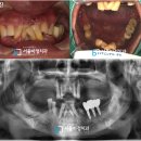 서울바정치과의원 | 불광치과 [교합 무너진 치아, 네비게이션, 가이드 임플란트 식립]케이스 후기 -서울바정치과