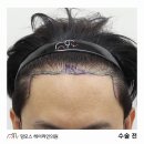 헤어by901 | 타병원 재수술 모발이식 디자인과 수술 후기 - 40대 남자