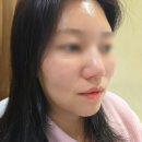 신사역 성형외과 민트실리프팅 내돈내산 일주일차 후기 ㅣ효과 통증 주의 사항