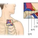 흉곽출구 증후군 (손가락 손저림, 오른쪽 왼쪽 팔저림, 가슴통증) 이미지