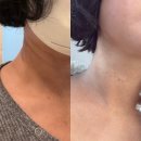 공간정리전문가(목) | 강남역 목주름필러 에르넥주사 리터치 2회차 받고 온 이야기