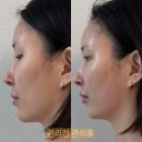 나를위한 에스테틱 | 진주 윤곽관리 페이스핏톡스 관리 후기 가좌동 나를위한온도 에스테틱
