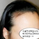 이마넓은여자입니다.수술후1년정도지남.밀도좀봐주세요 이미지