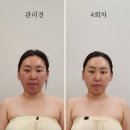청우에너지 | 울산웨딩관리 아뜰리에드스킨 윤곽관리 테라노바 4회차 달라진 얼굴선 안색변화
