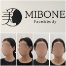 w. 미본 강남점 작은 얼굴 페이스케어 후기 ( 5회차/ 10회차 비교사진 )