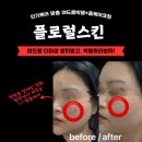 플로럴 | 대전여드름관리 전문 플로럴스킨, 여드름박멸 케어 후기