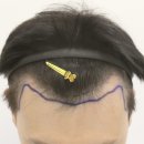 부산 맘모스헤어라인의원 이미지