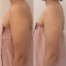 제이메디 | 송도 팔뚝관리 엔더몰로지 팔뚝살 후기 제이메디스킨